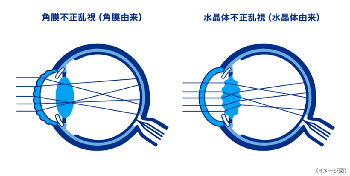 角膜不正乱視（角膜由来）水晶体不正乱視（水晶体由来）