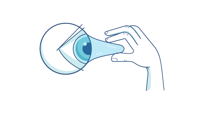 An illustration of the myth that contact lenses can get stuck to your eye.