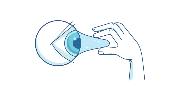 Illustration of a contact lens getting stuck to an eyeball