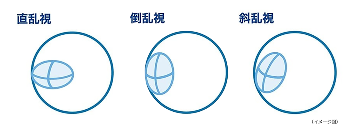 （イメージ図）直乱視・倒乱視・斜乱視