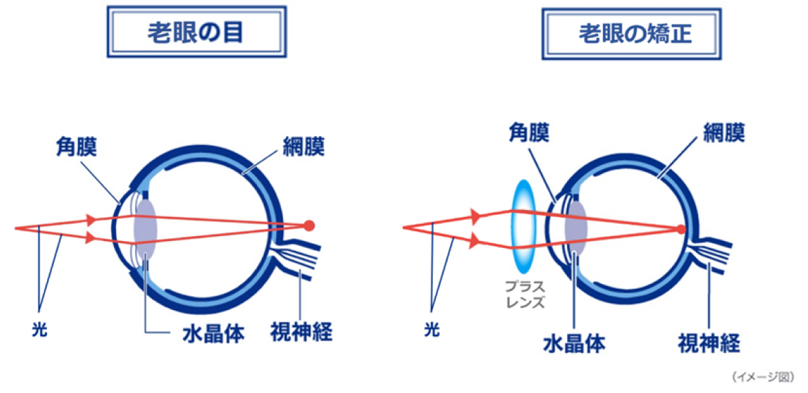 老眼の目 老眼の矯正