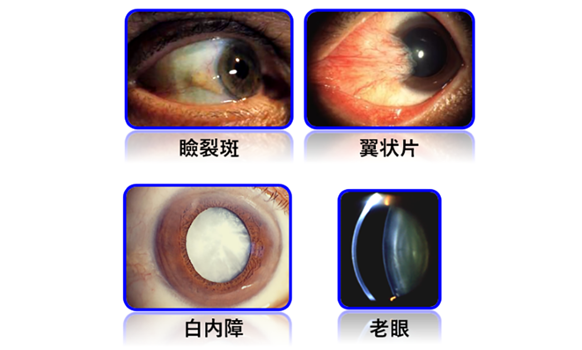 瞼裂斑、翼状片、白内障、老眼