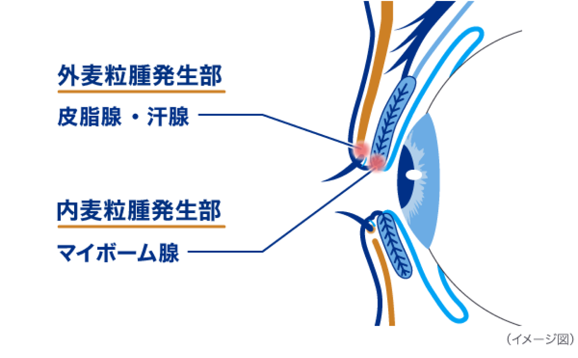 外麦粒腫発生部 皮脂腺・汗腺 内麦粒腫発生部 マイボーム腺 イメージ図 外麦粒腫発生部 皮脂腺・汗腺 内麦粒腫発生部 マイボーム腺 イメージ図