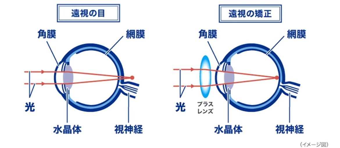 遠視の目 遠視の矯正