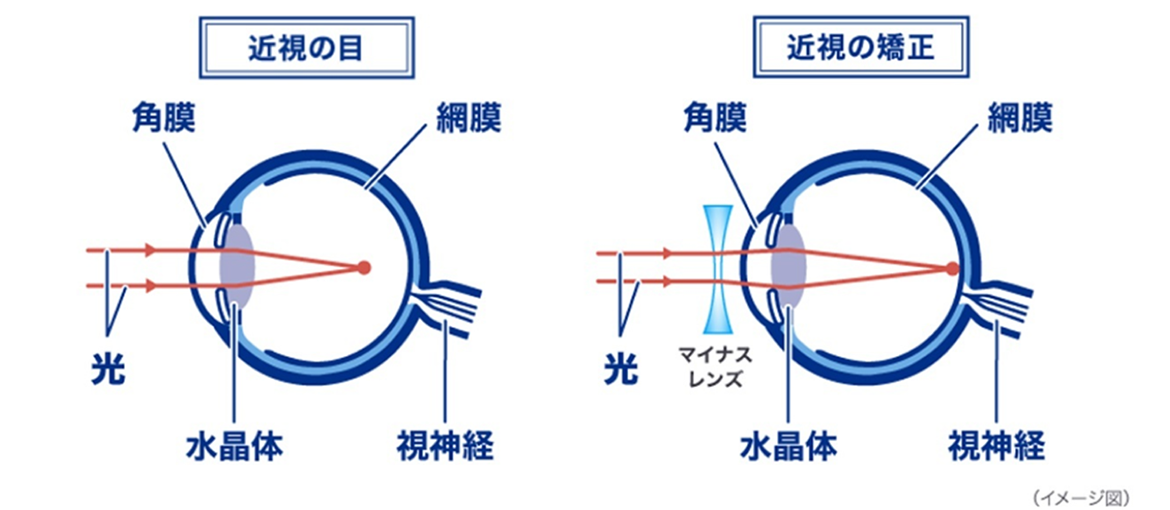 イメージ図：近視の目と近視の矯正