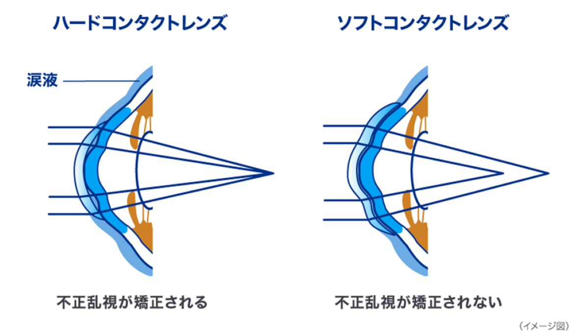 ハードコンタクトレンズ ソフトコンタクトレンズ