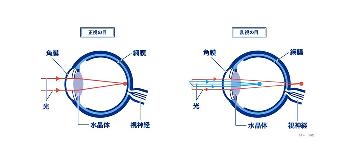 (イメージ図)正視の目と乱視の目 (イメージ図)正視の目と乱視の目