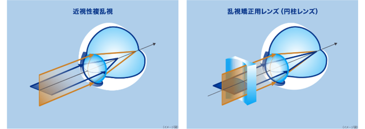 近視性複乱視 乱視矯正用レンズ（円柱レンズ）