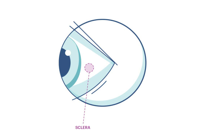 An illustration showing where the sclera is in the eye.