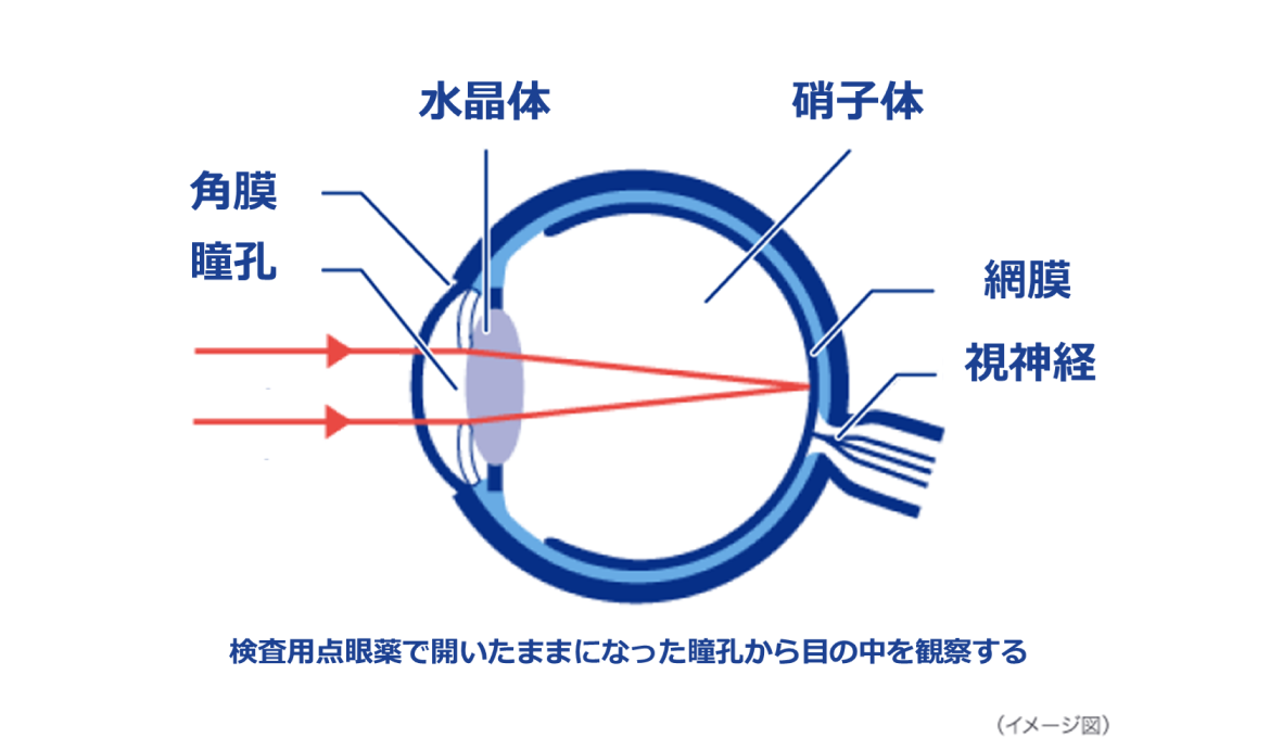 検査用点眼薬で開いたままになった瞳孔から目の中を観察する