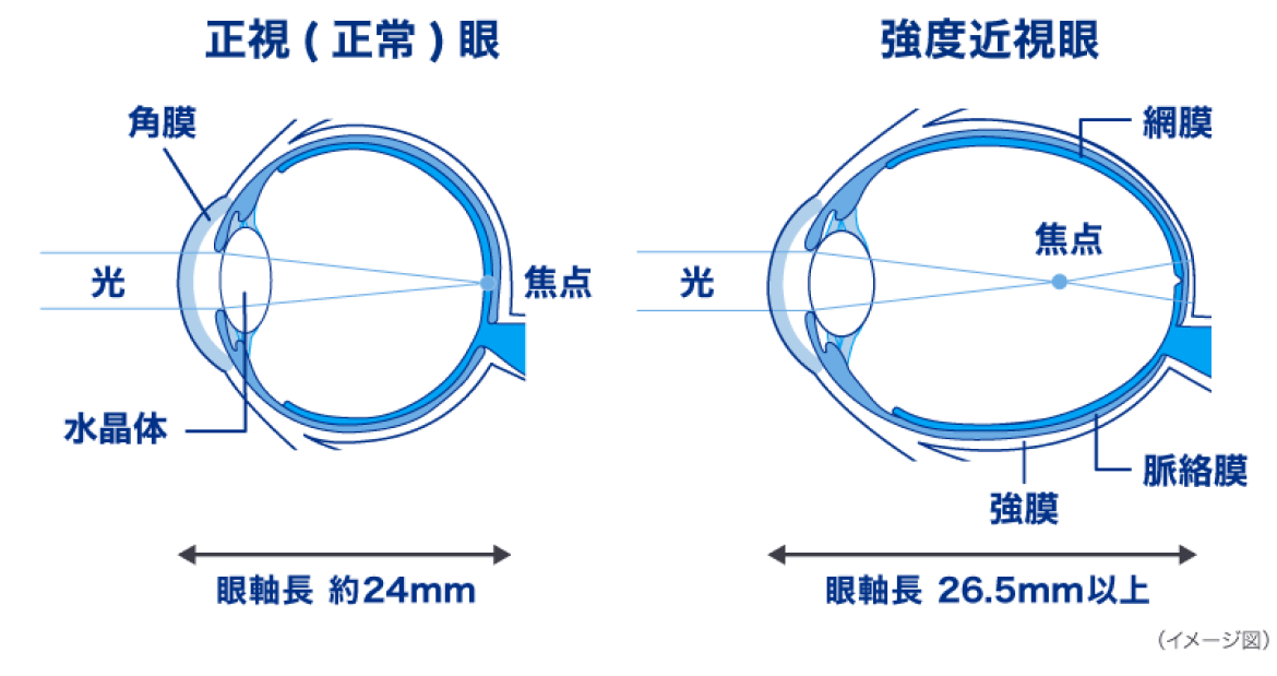 正視（正常）眼　強度近視眼