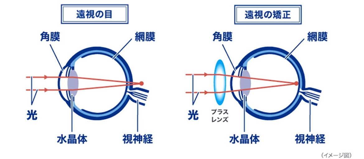 遠視の目 遠視の矯正