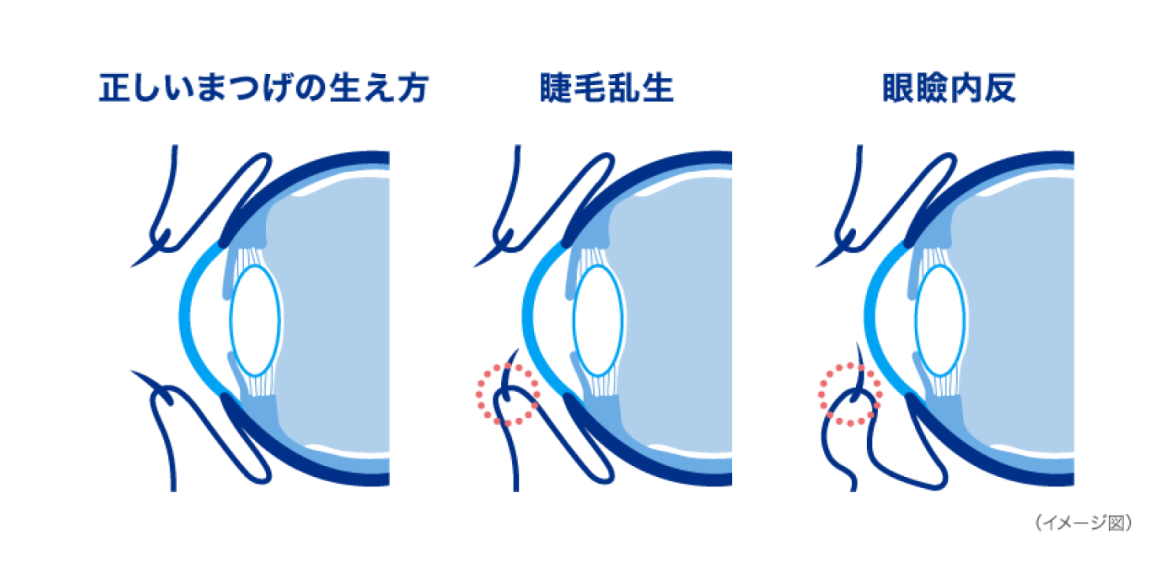 正しいまつげの生え方　睫毛乱生　眼瞼内反　〈イメージ図〉