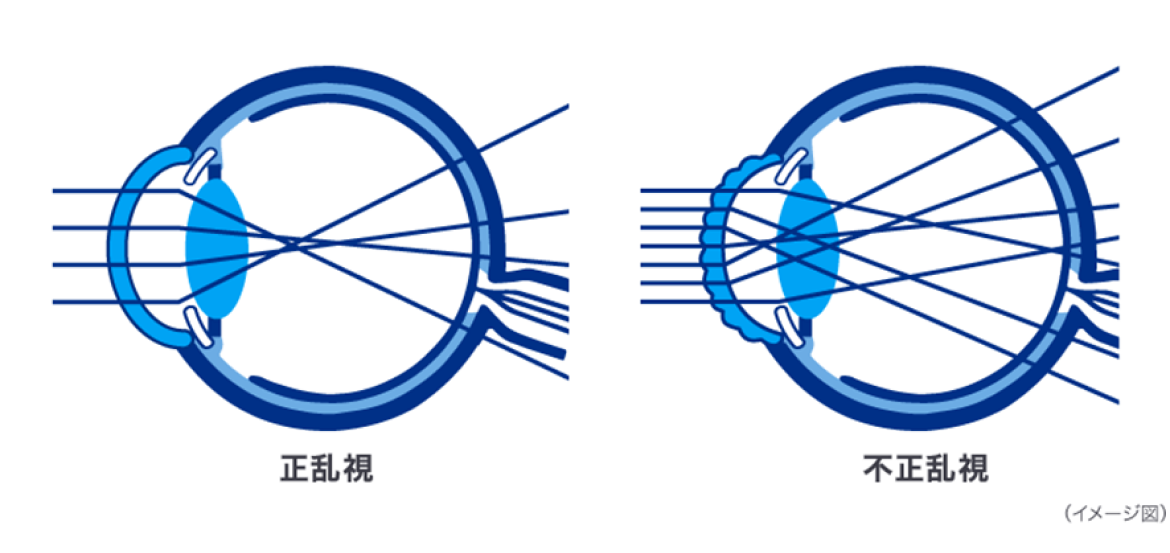 正乱視 不正乱視