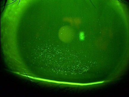 ドライアイ ドライアイ