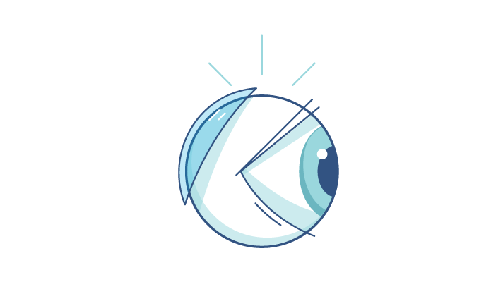 An illustration of the myth that contact lenses can get lost behind your eye.