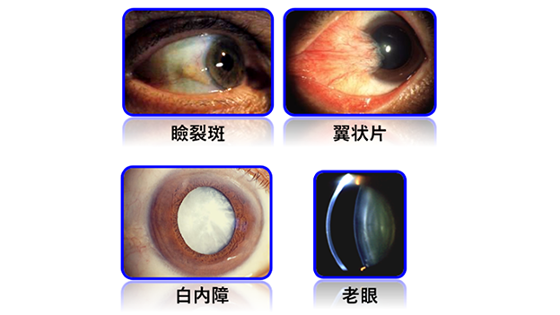 瞼裂斑、翼状片、白内障、老眼の写真 瞼裂斑、翼状片、白内障、老眼の写真