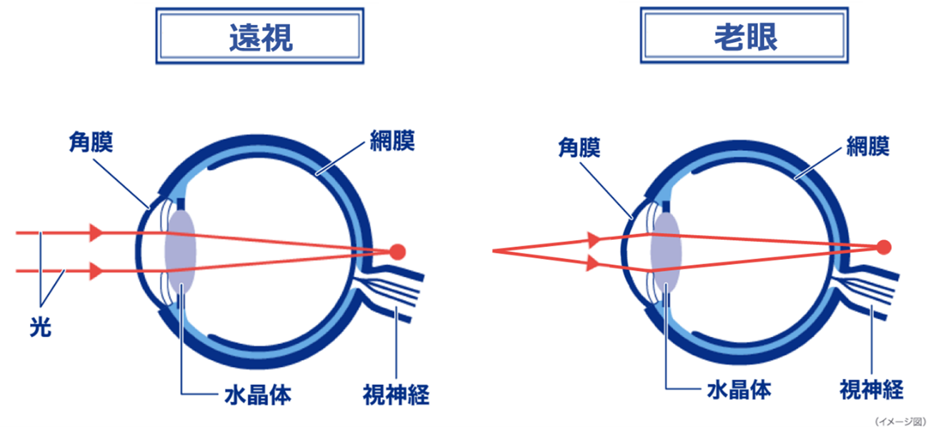 遠視 老眼