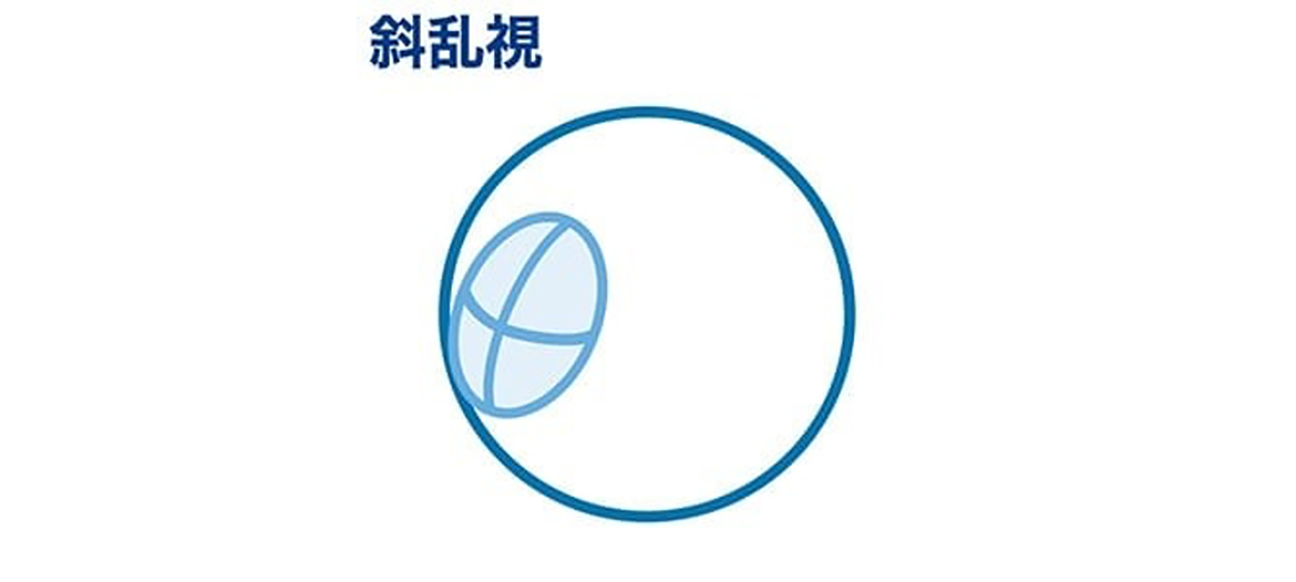 斜乱視
