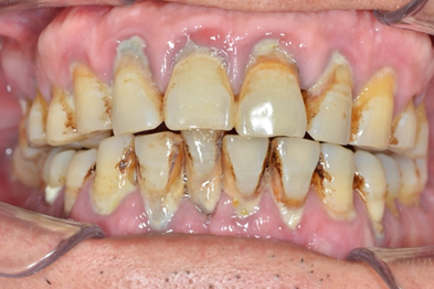 牙石常見位置