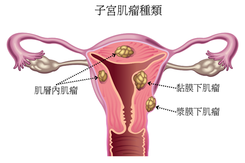 子宮肌瘤種類