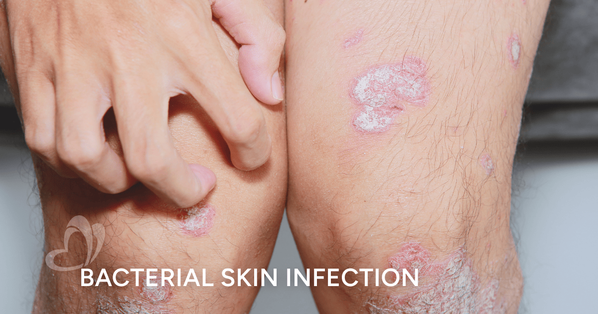 Bacterial Skin Infections | Thomson Medical