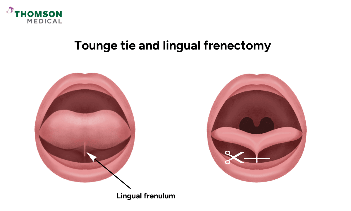 image of tounge tie and lingual frenectomy