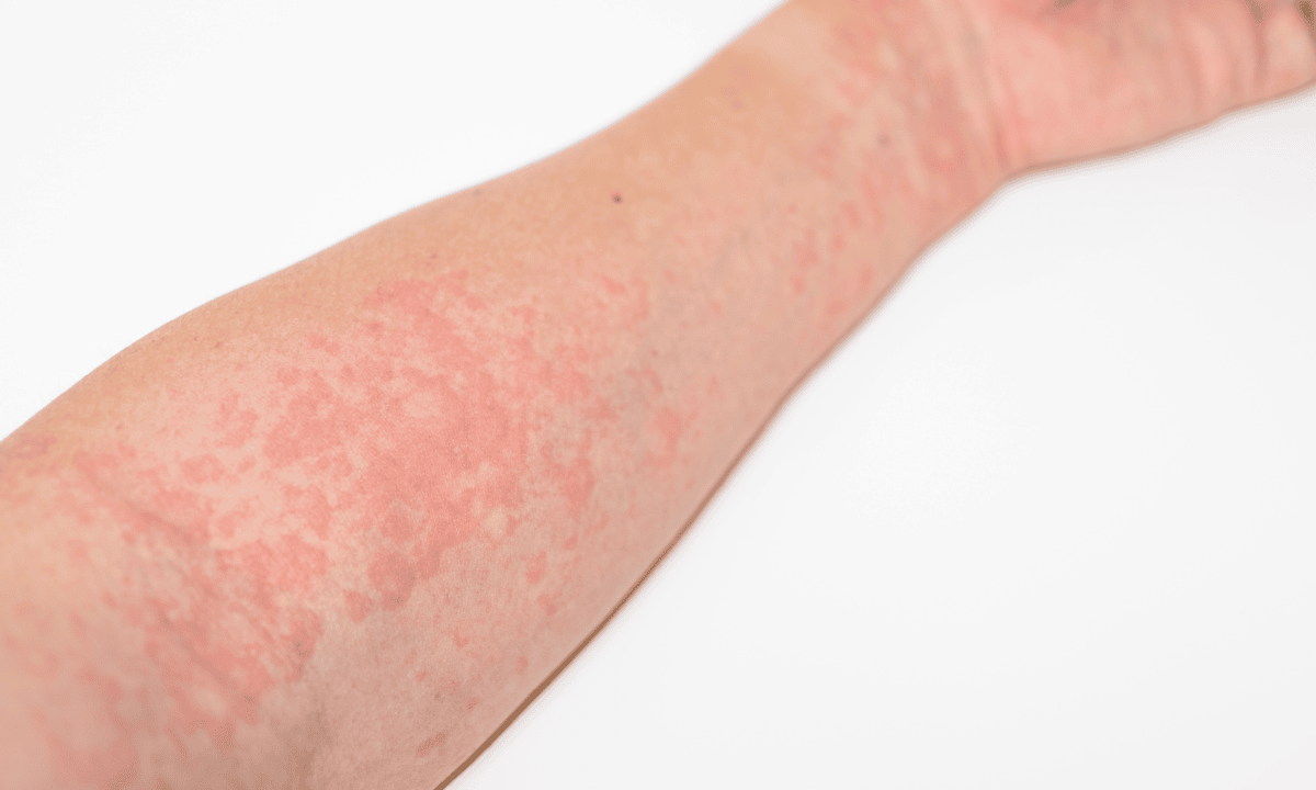 Hives on an arm