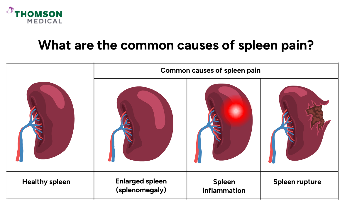 Illustration of the common causes of spleen pain