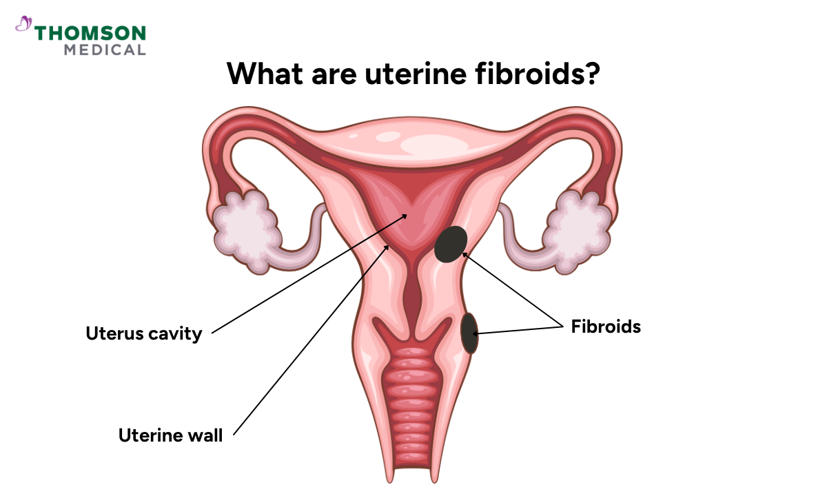 Illustration of uterine fibroids