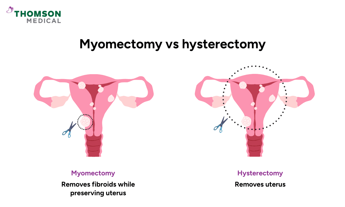 image of myomectomy vs hysterectomy