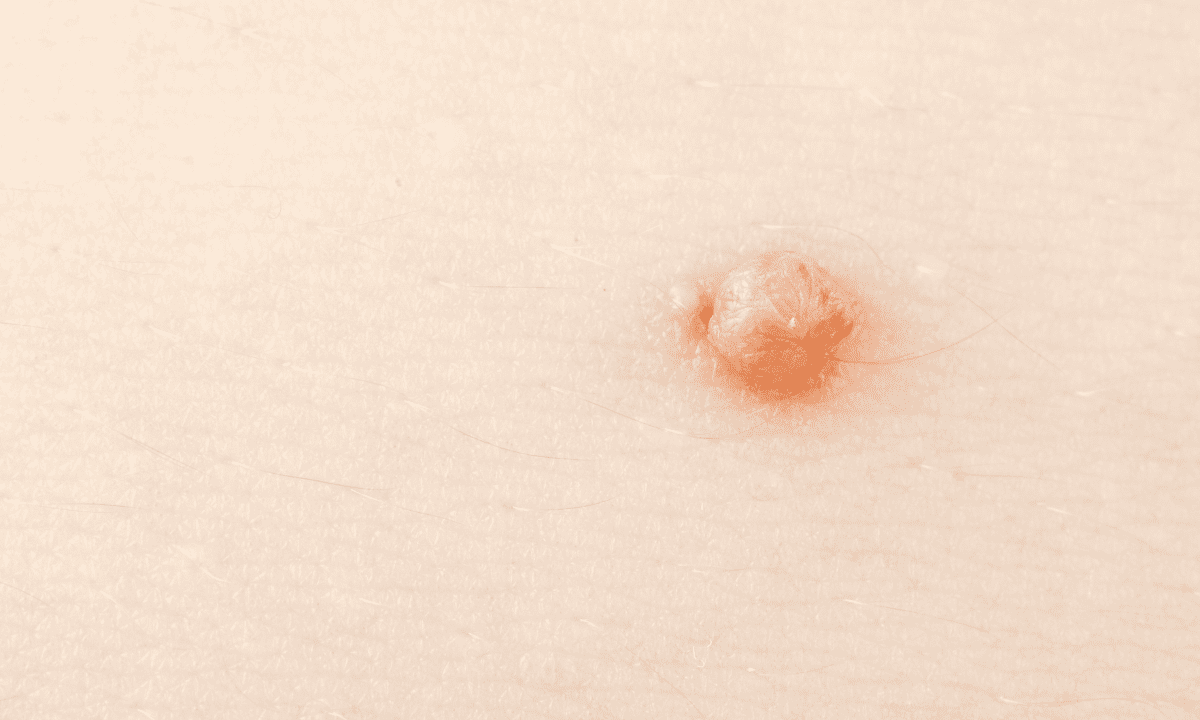 A close-up medical photograph of a single, raised, flesh-colored wart on the skin.