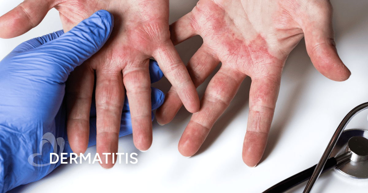 Dermatitis | Thomson Medical