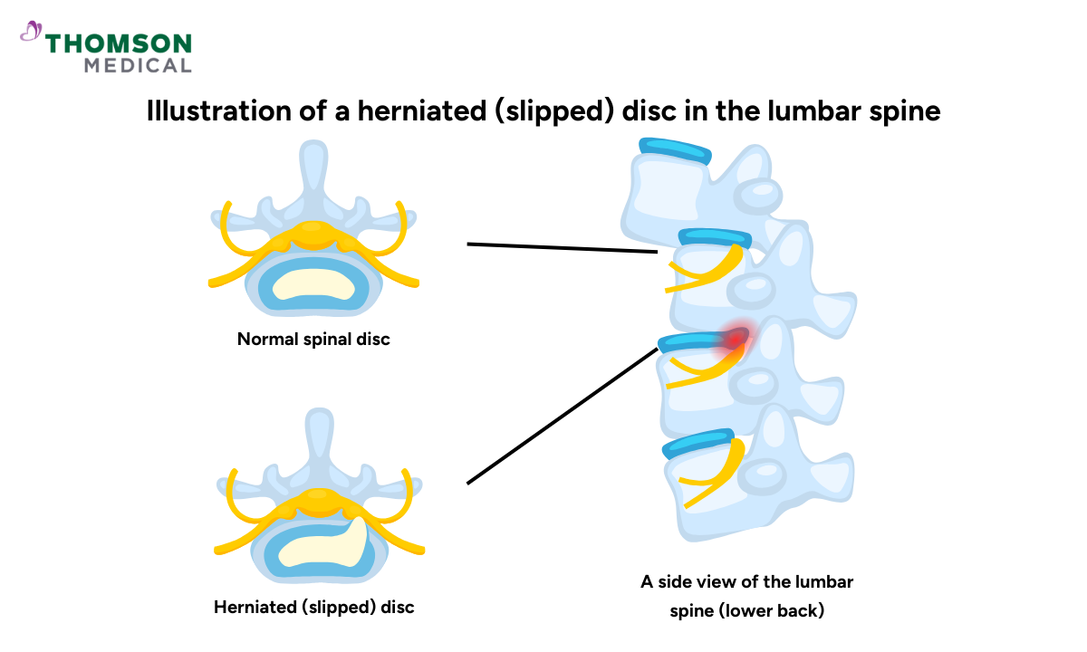 blog-image_screening_normal-disc-vs-herniated-disc-mri.png