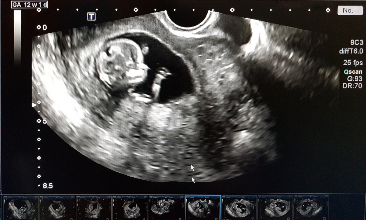Ultrasound Scan