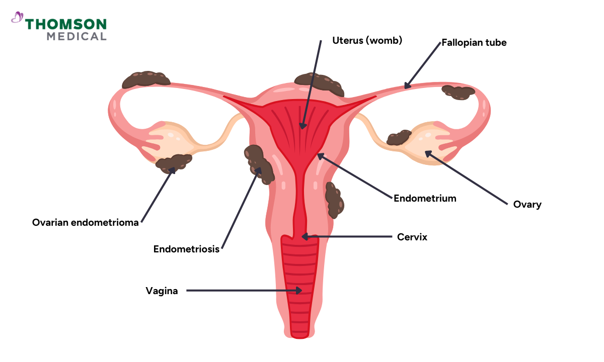 obgyn_ovarian-endometriosis_blog-images.png