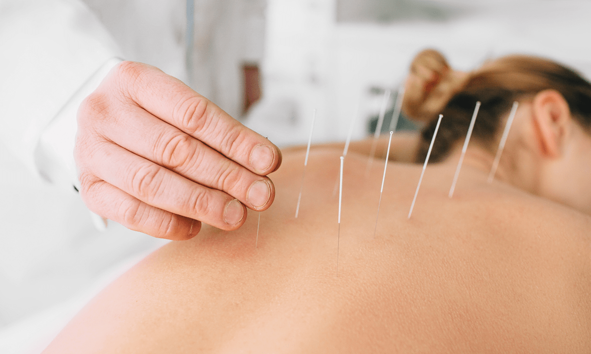 Women experiencing acupuncture by acupuncturist