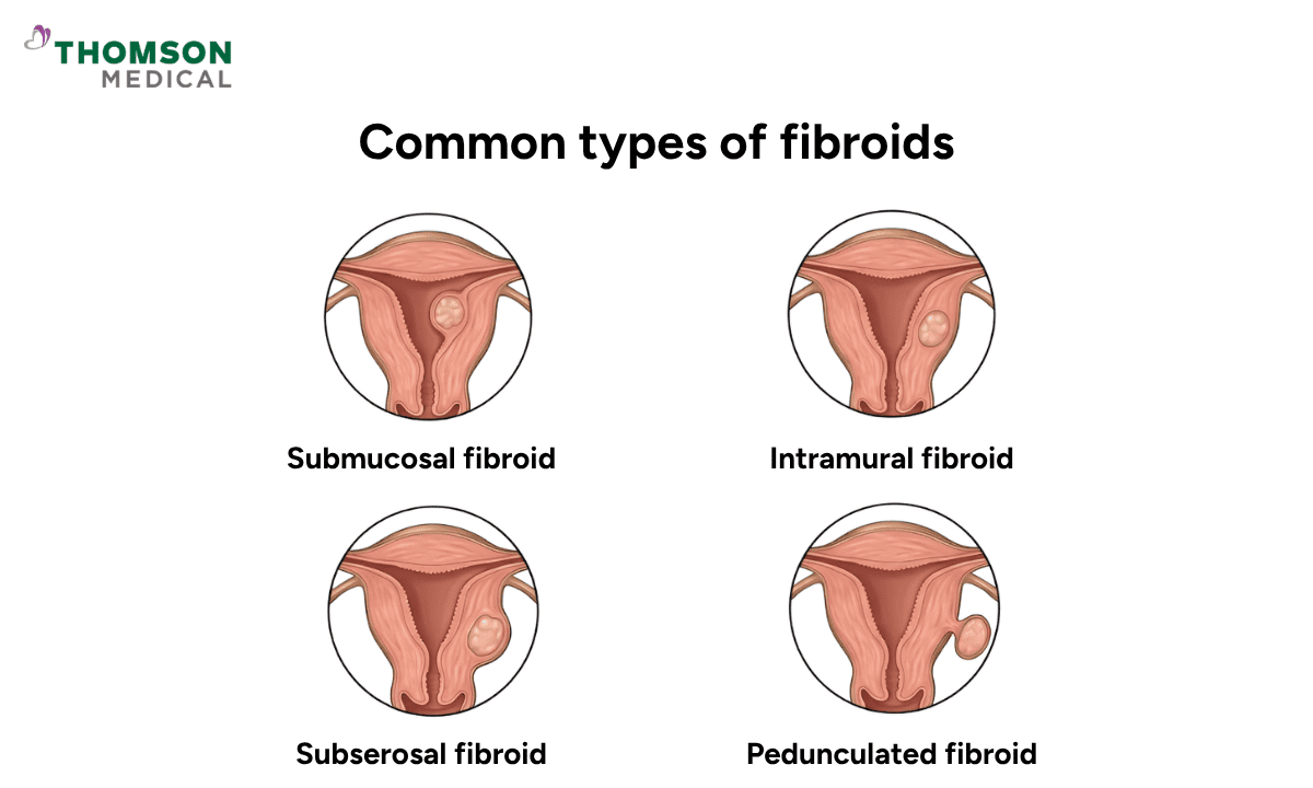 common types of uterine fibroids