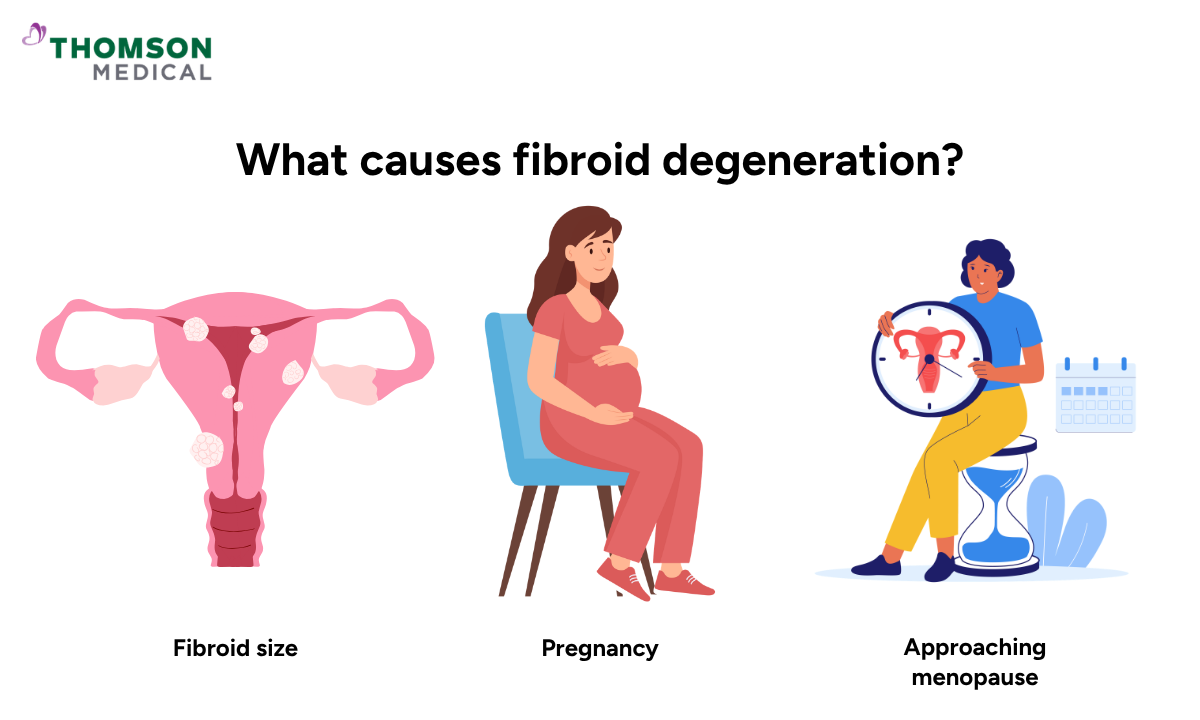 Illustration shows the causes fibroid degeneration