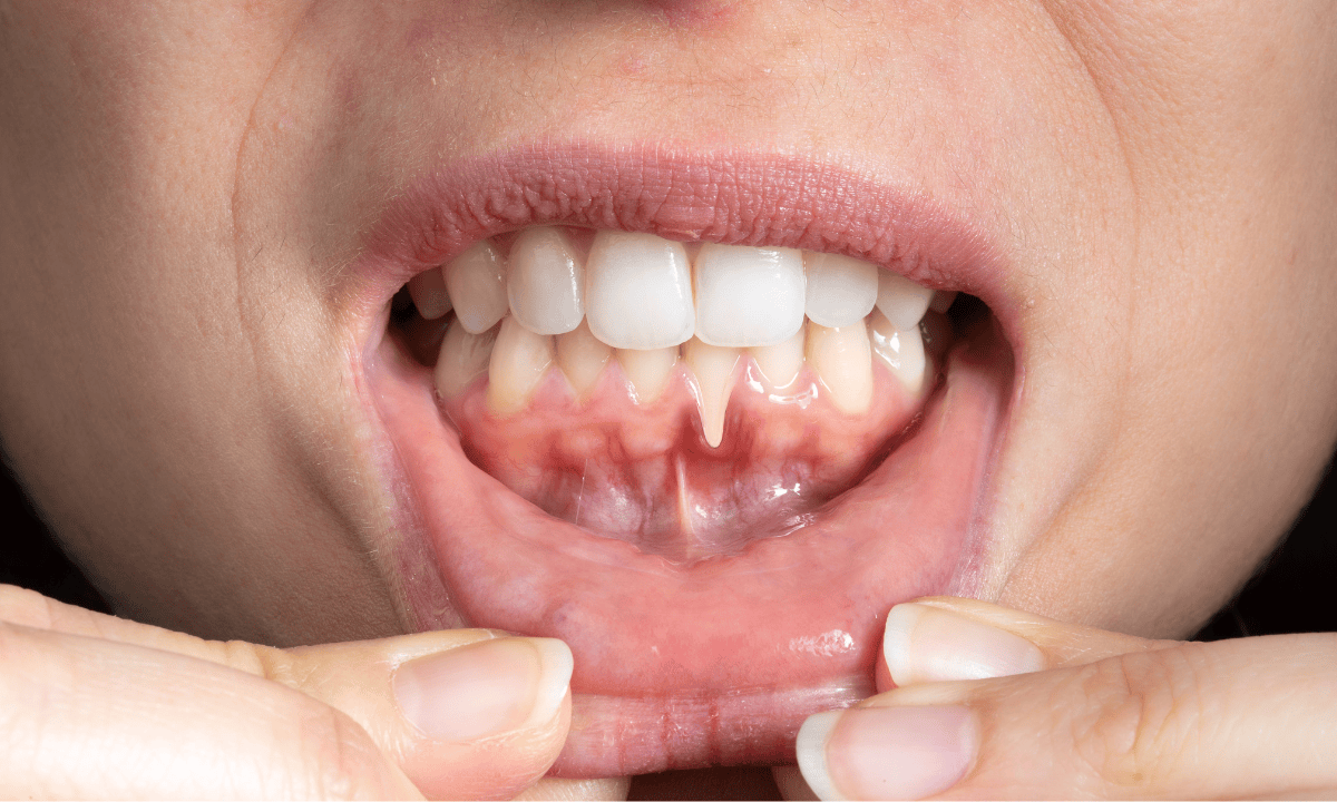 image of receding gums