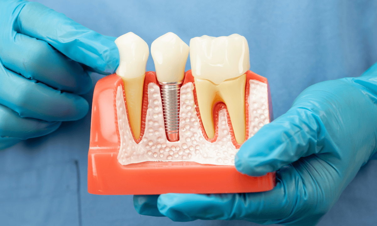 replacing a tooth with a dental implant