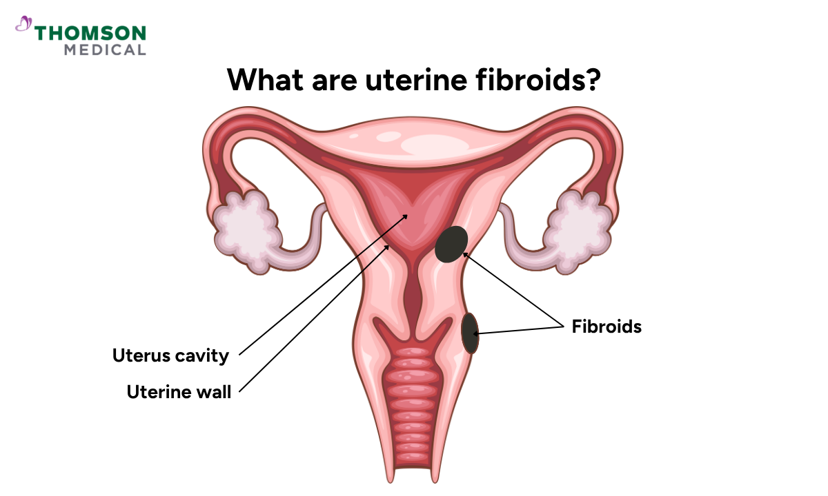 Illustration shows uterine fibroids