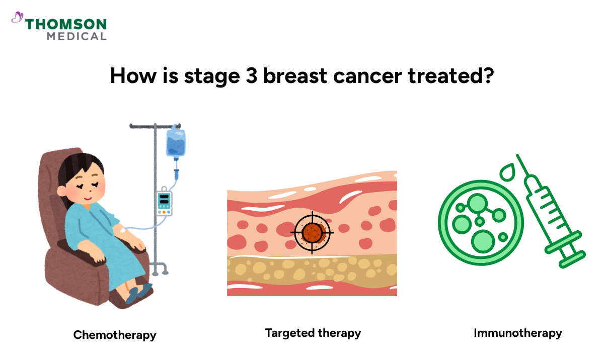 Illustration of how stage 3 breast cancer is treated