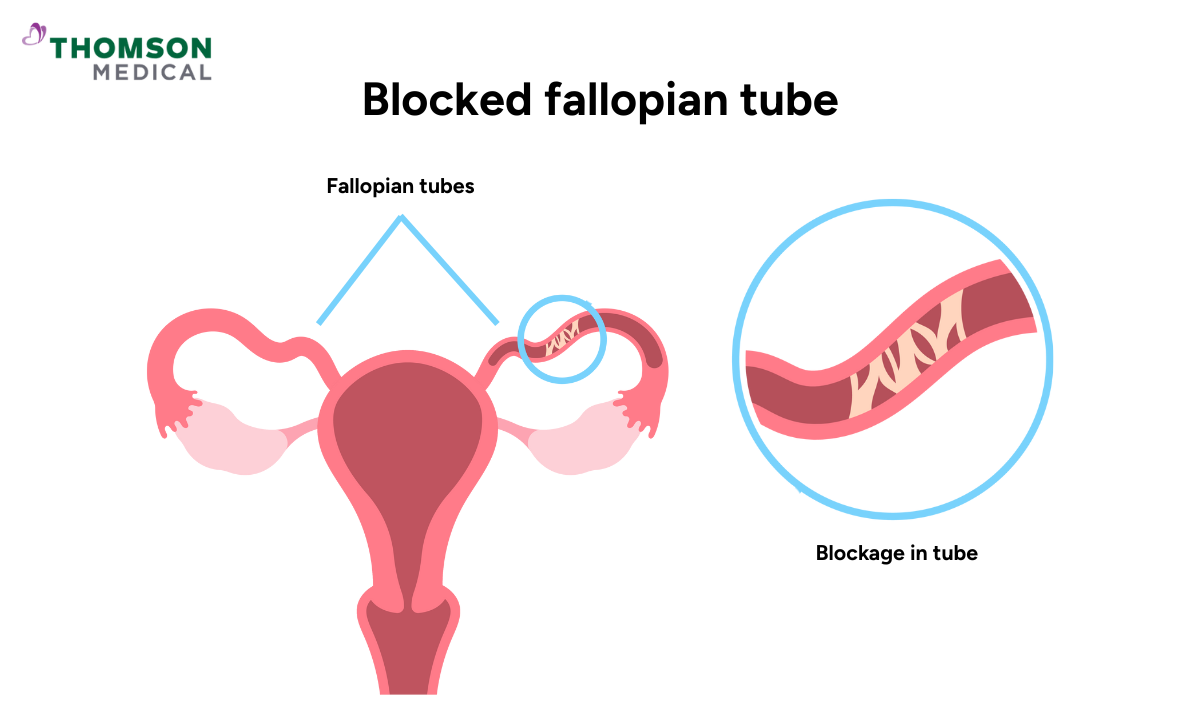 illustration of one blocked fallopian tube