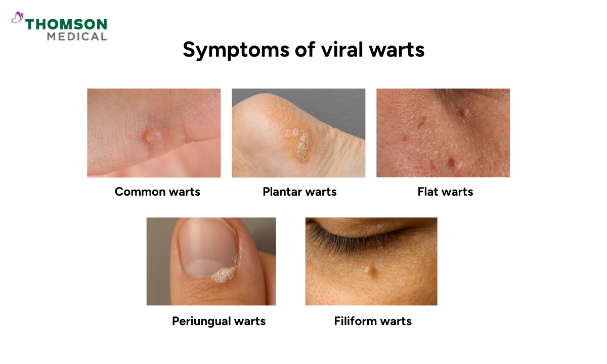 Illustration of symptoms of viral warts