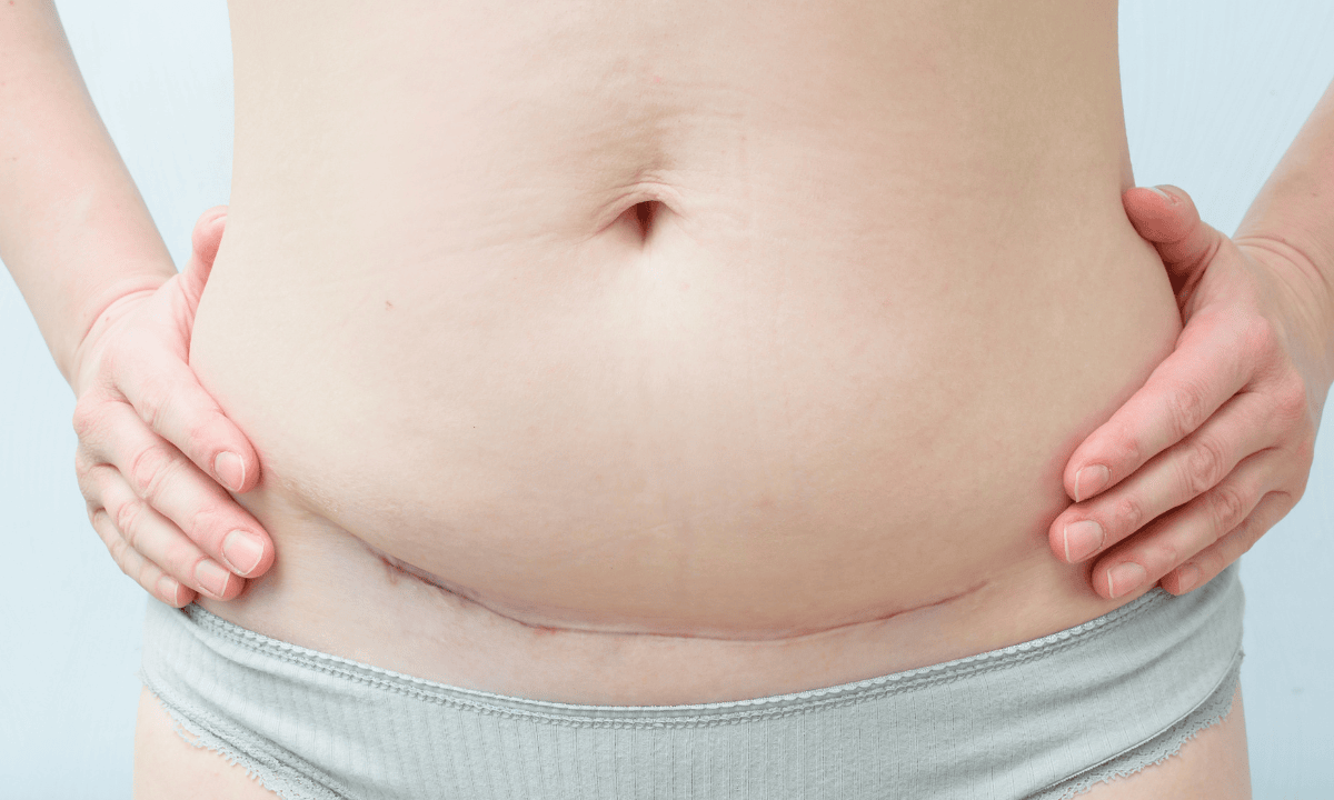 illustration of c-section scar