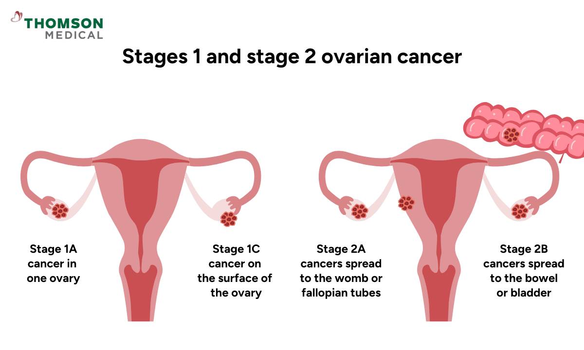 illustration of ovarian cancer stages