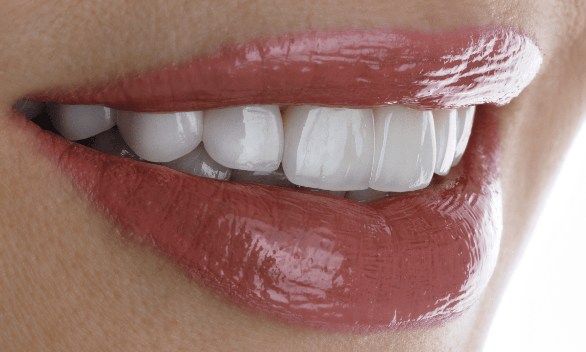 Close up of porcelain dental veneers