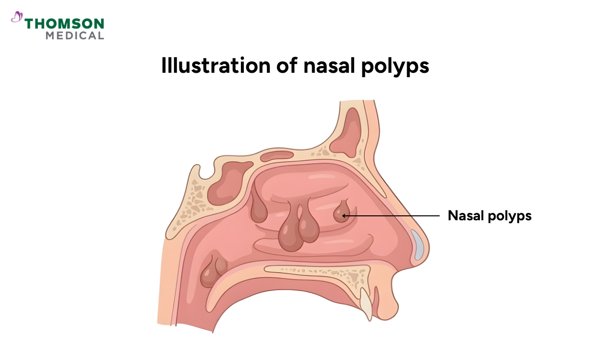 A medical illustration of a human nasal cavity showing fleshy, noncancerous growths labeled nasal polyps.
