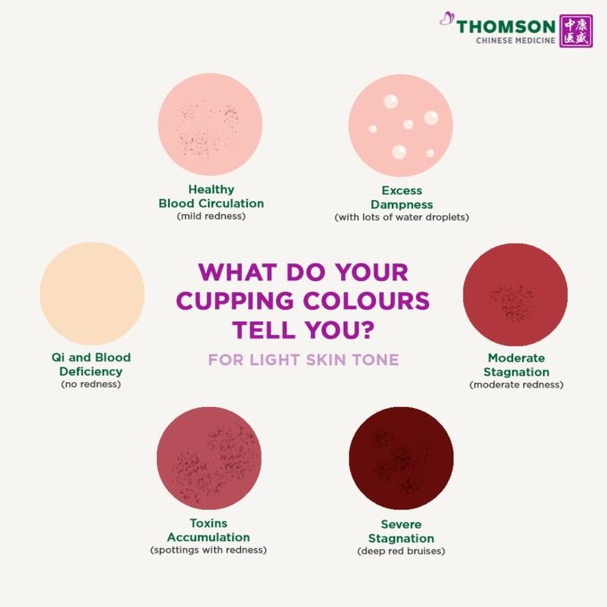 What Do Your Cupping Colours Tell You? | Thomson Medical